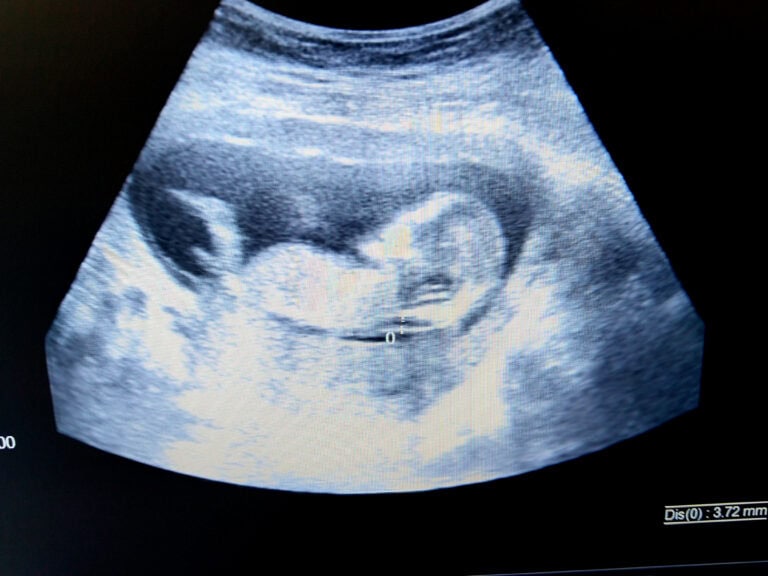 Increased,Nuchal,Translucency,In,Fetus,By,Ultrasound